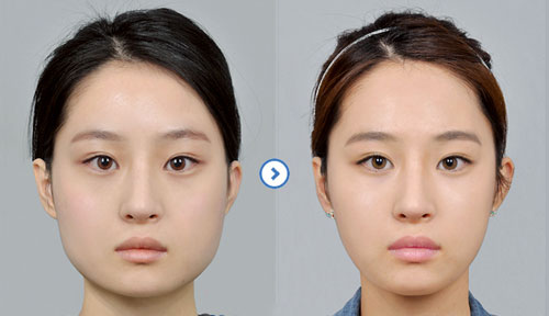 改脸型整形手术有哪些方法