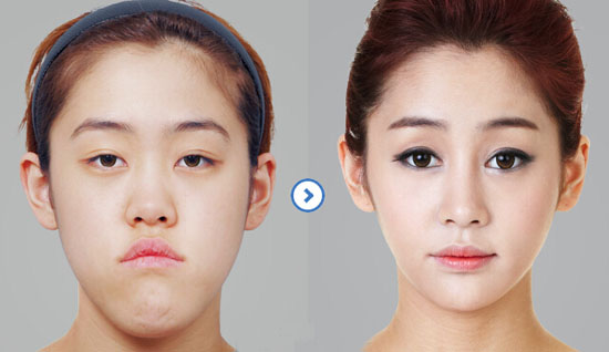韩国改脸型手术需要多少钱?